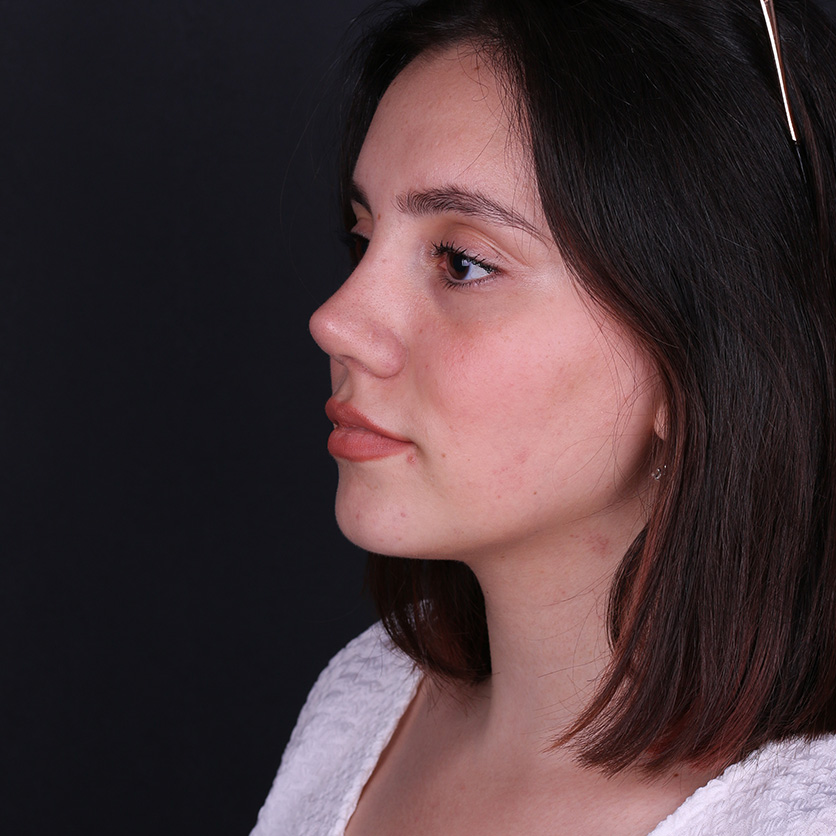 Primary rhinoplasty in Turkey natural nose surgery result