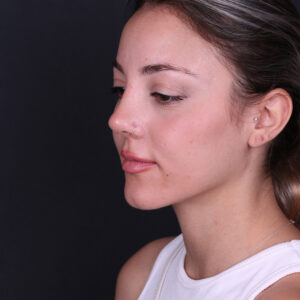 Ear surgery in Turkey ear correction before and after result