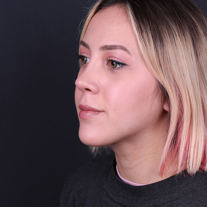 Functional septorhinoplasty in Turkey breathing and nasal correction result