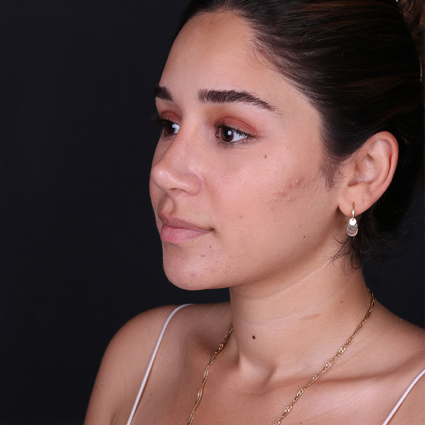 Ultrasonic rhinoplasty in Turkey precise bone reshaping result