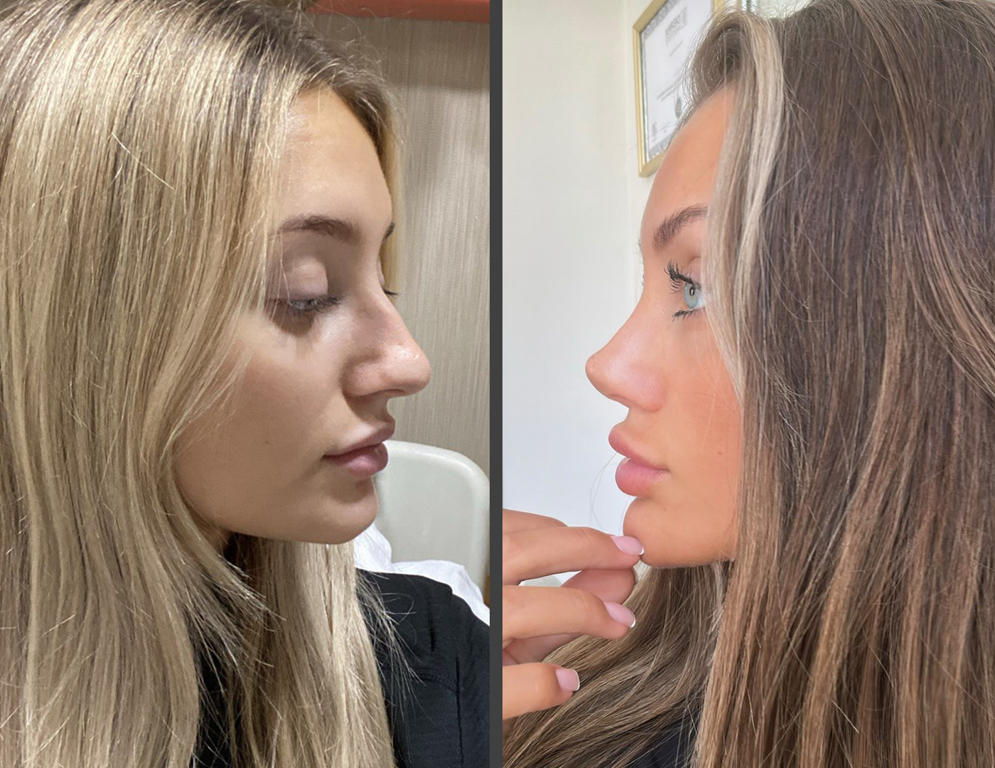 Sofia after primary rhinoplasty showing smooth dorsal profile, refined tip and natural facial balance