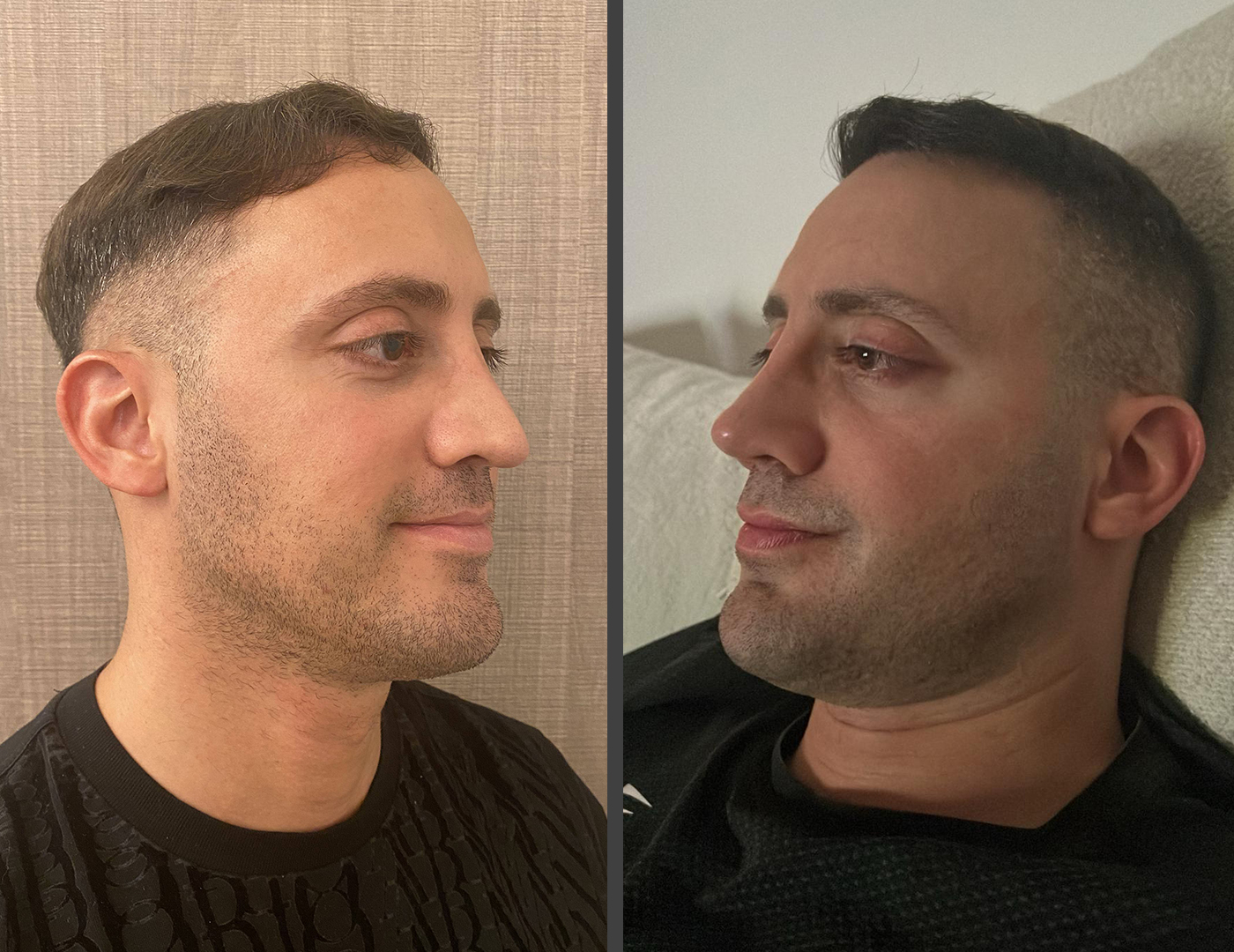 Elias after revision rhinoplasty showing stable nasal structure and natural masculine balance