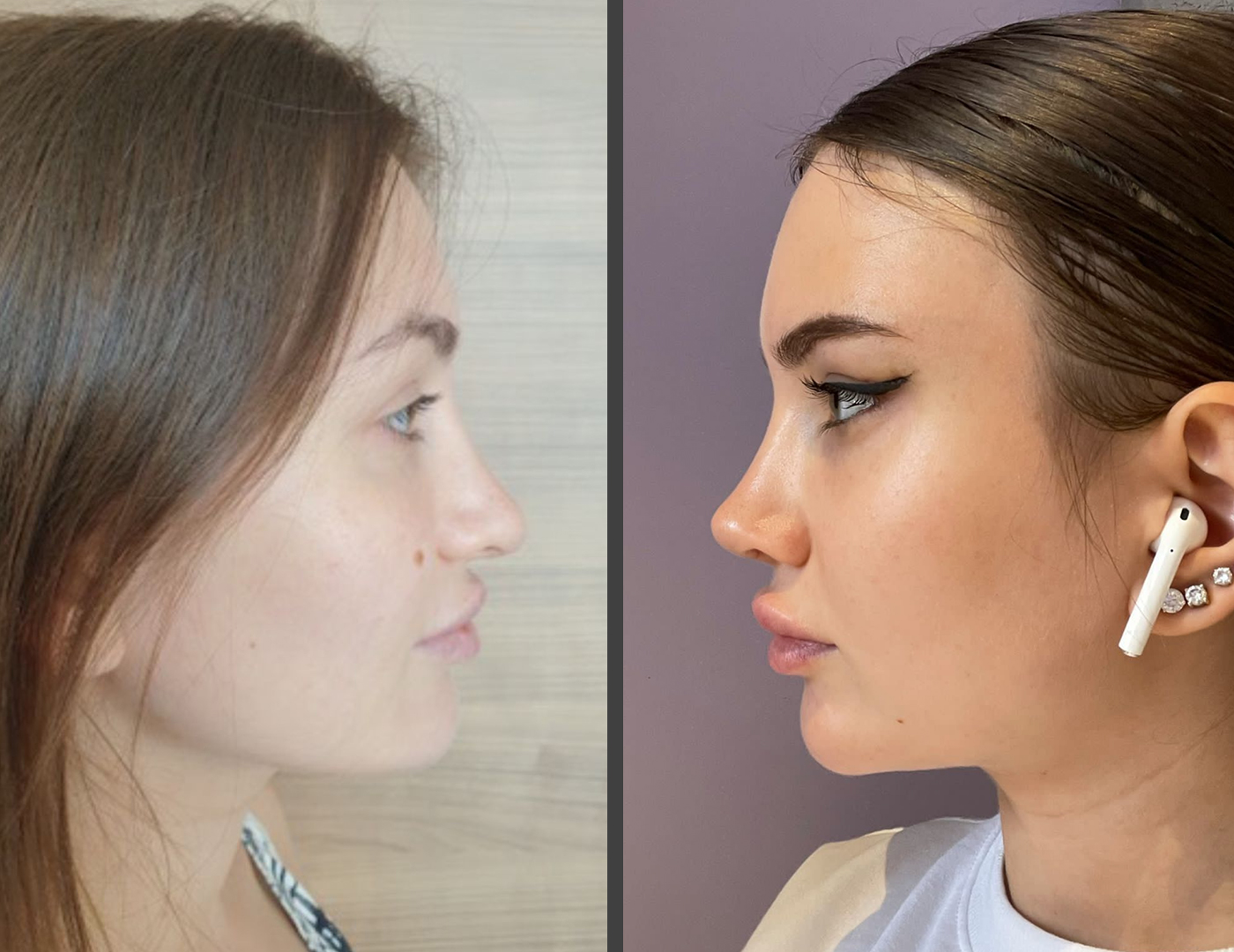 Cristina after revision rhinoplasty showing natural nasal refinement and balanced facial proportions