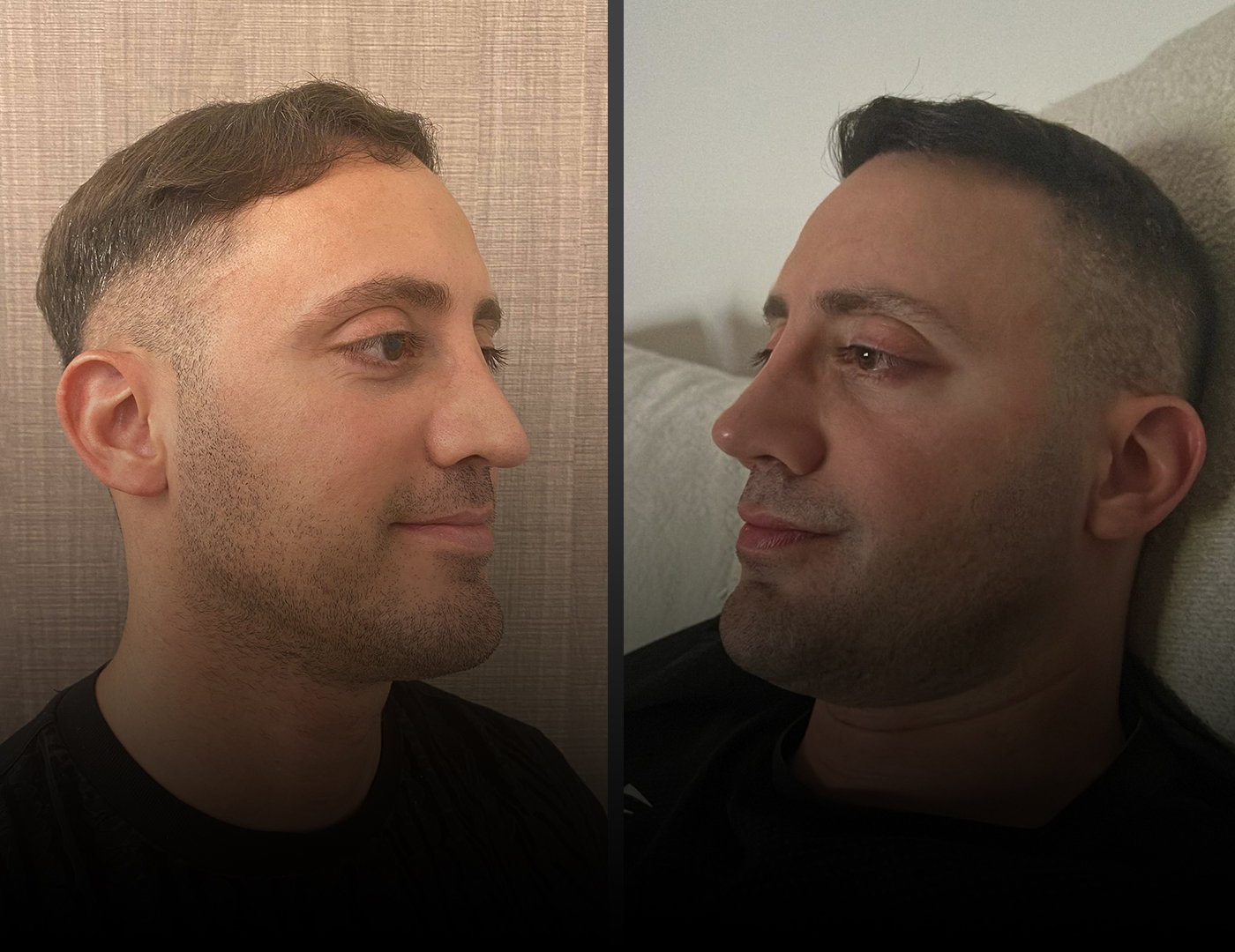 ENT assessment for rhinoplasty for breathing problems in UK patient