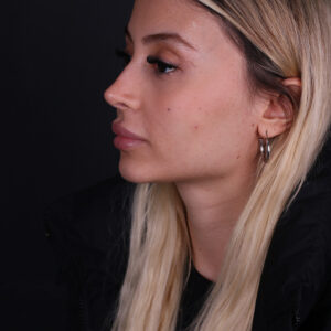 Neck lift in Turkey jawline and neck rejuvenation before and after result