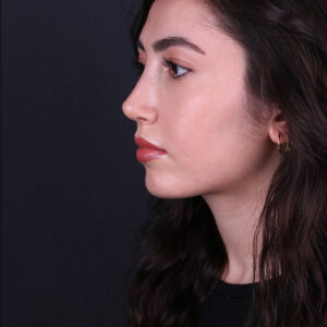 Chin augmentation in Turkey facial balance before and after result