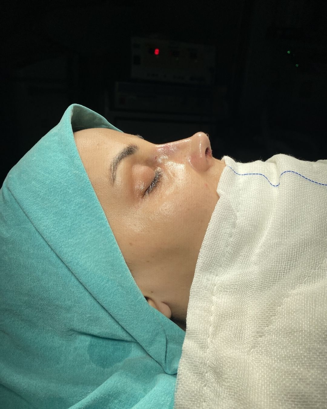 Septoplasty vs septorhinoplasty comparison showing internal nasal correction and structural changes affecting breathing