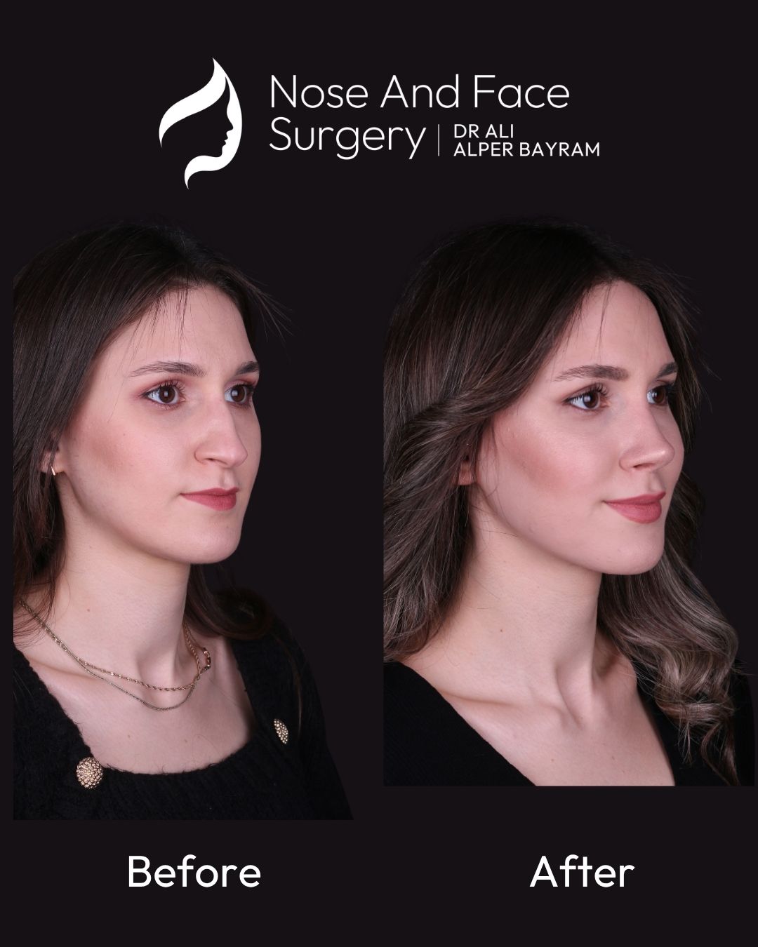 Deviated septum surgery showing internal nasal correction to improve airflow and breathing